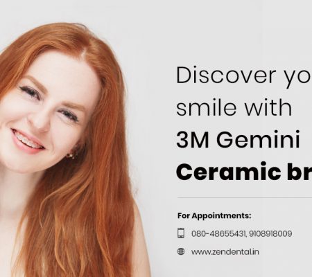 3M Gemini Ceramic braces